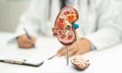 kidney stones in toilet