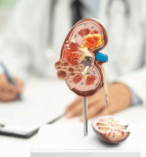 kidney stones in toilet