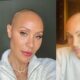 jada pinkett smith hair loss